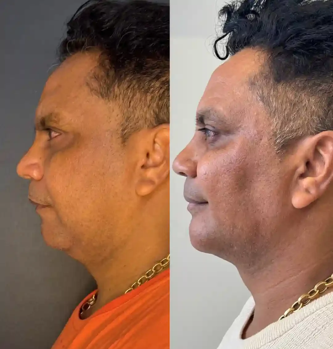 Facetas de Resina