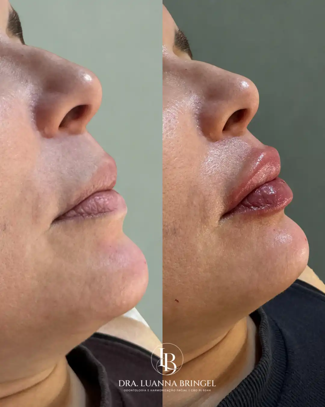 Preenchimento Labial