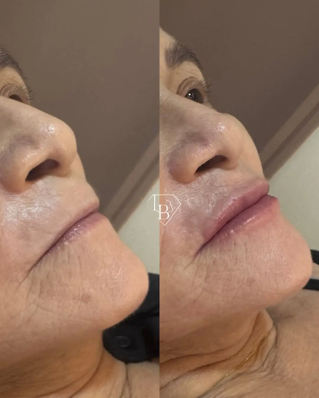 Preenchimento Labial Teresina