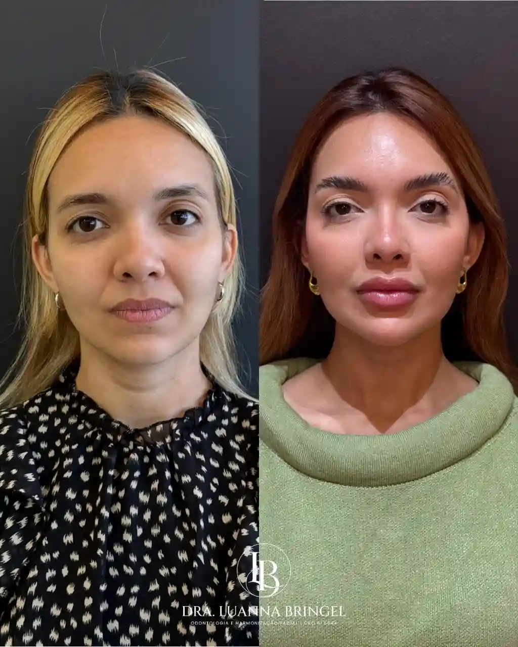 Full Face Harmonização