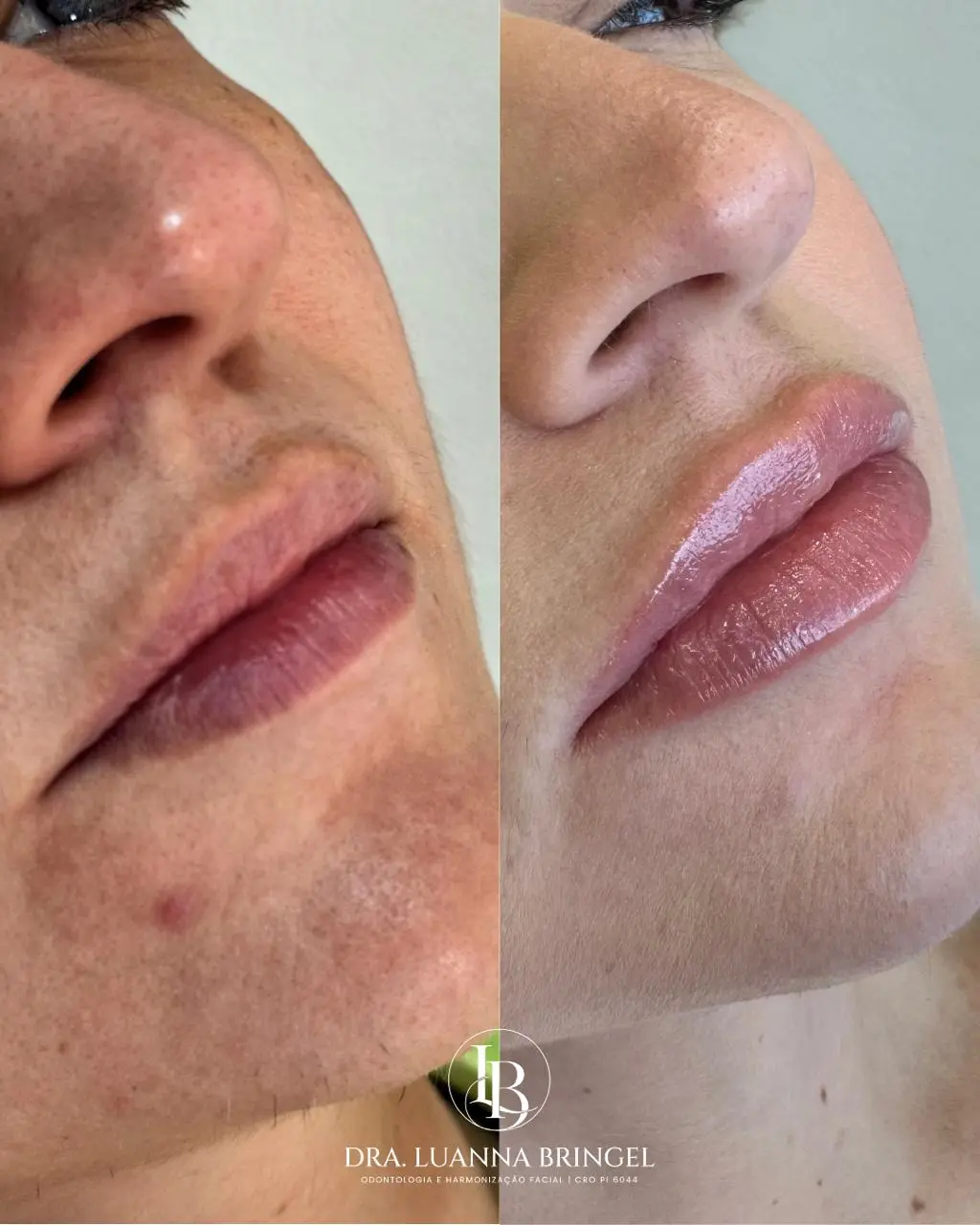 Preenchimento Labial 2
